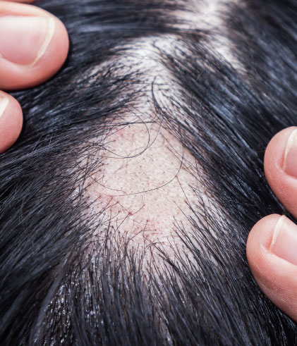 Possible Alopecia Areata Triggers That Affect Men & Women