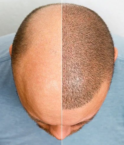 What are the early symptoms of baldness?