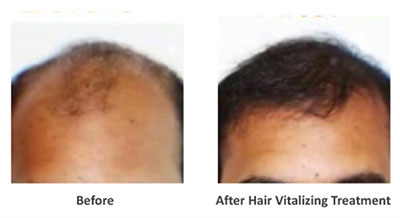 Dr Batra S Best Homeopathic Hair Loss And Alopecia Treatment For Men Women In Uae