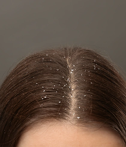 Combating Dandruff in the Summer Heat: Effective Homeopathy Solutions