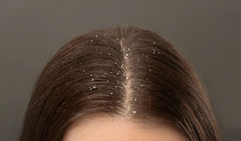 Combating Dandruff in the Summer Heat: Effective Homeopathy Solutions