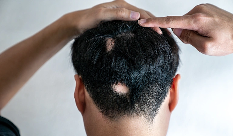 Home Remedies for Alopecia