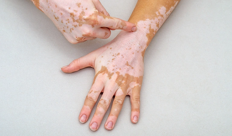 Prevent Vitiligo from Spreading