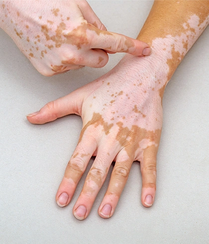 Prevent Vitiligo from Spreading