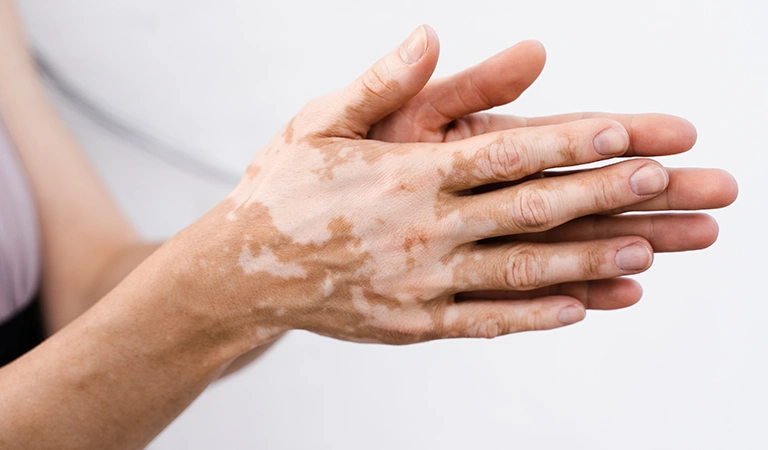 Can Vitiligo Be Prevented