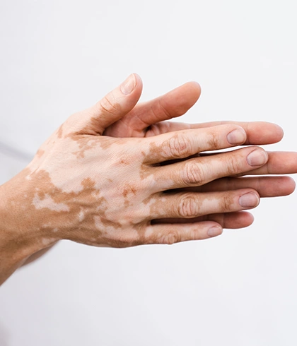 Can Vitiligo Be Prevented