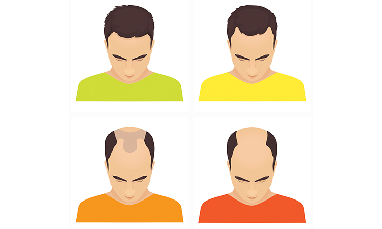 The Best Ways To Combat A Receding Hairline 