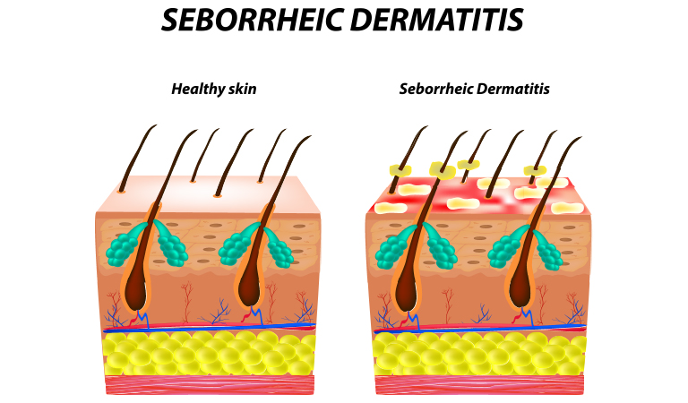 Is Dandruff or Seborrheic Dermatitis Contagious? | Dr Batra’s ...