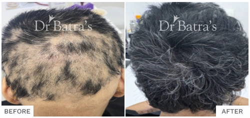 Alopecia Areata